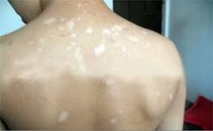 治疗中的白癜风病人需要特别注意些什么